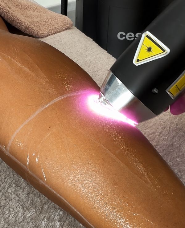 Épilation laser au cabinet Koralia à Toulon